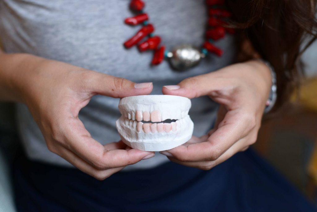 Smile Brilliant teeth whitening cast before